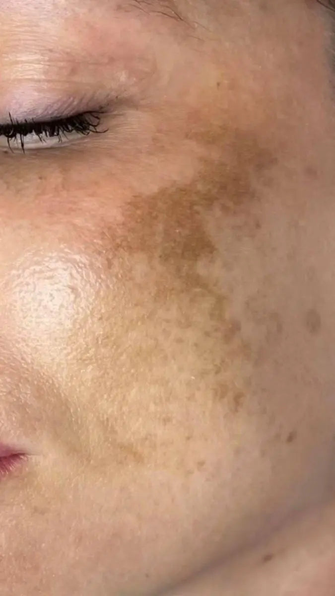 Reason for Pigmentation on Face