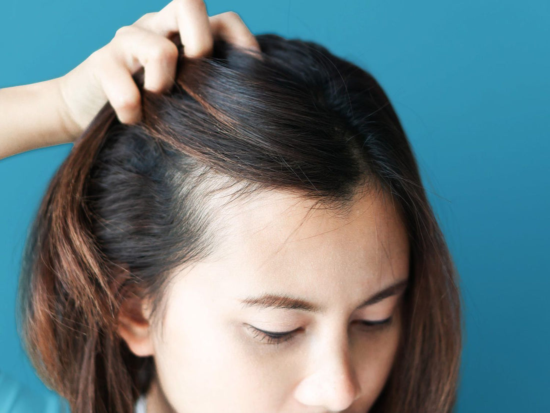 The Role of Scalp Care in Preventing Dandruff