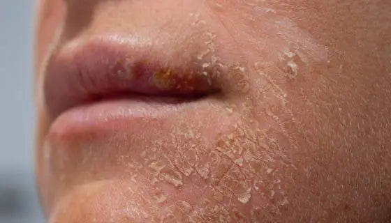Best Moisturizers for Dry Skin Dermatologist Recommended