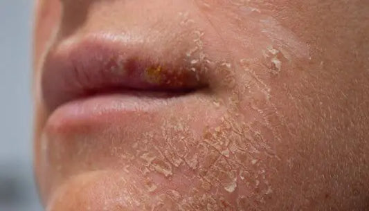 Best Moisturizers for Dry Skin Dermatologist Recommended