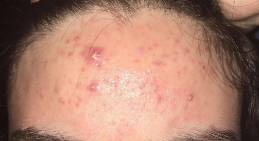 How To Get Rid Of Pimples On Forehead