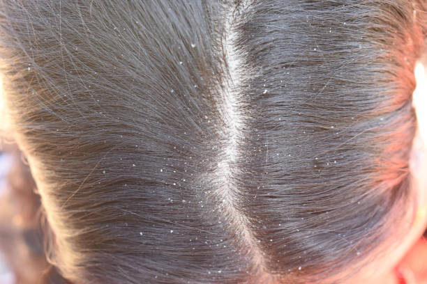 ‘Types of Dandruff’ You Should Definitely Know To Beat It Better At Its Game