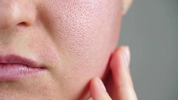 MYTH BUSTED: ABOUT OILY PORES