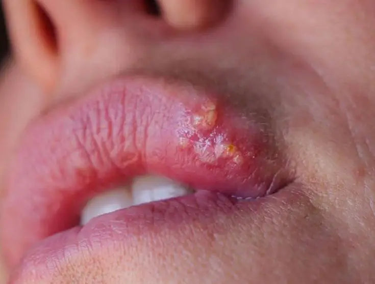 How To Get Rid Of Pimple On Lip