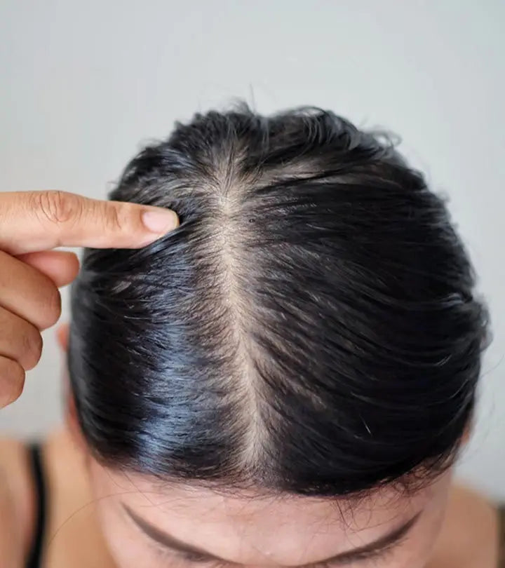 Oily Scalp Isn’t Helping? This Will!