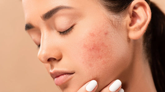 HORMONAL ACNE: UNDERSTAND FIRST TO SUCCEED