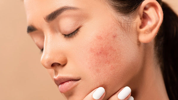 HORMONAL ACNE: UNDERSTAND FIRST TO SUCCEED