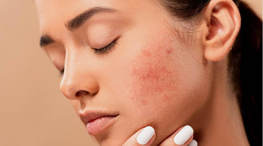 How to get rid of a blind pimple?