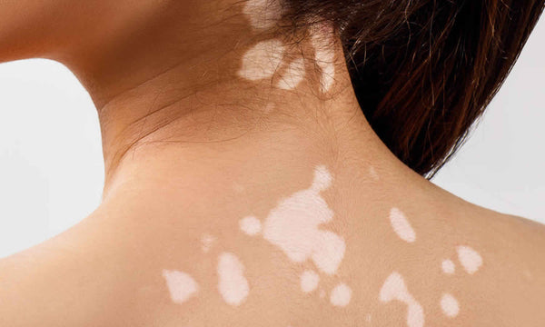 SKIN DISCOLOURATION: HOW TO TREAT THEM