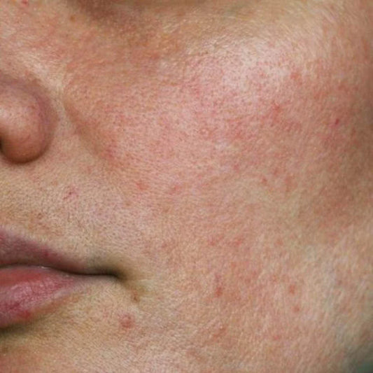 How To Repair Skin Barrier