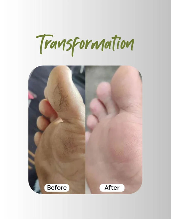 Foot Transformation result before and after of using Deyga Foot Butter