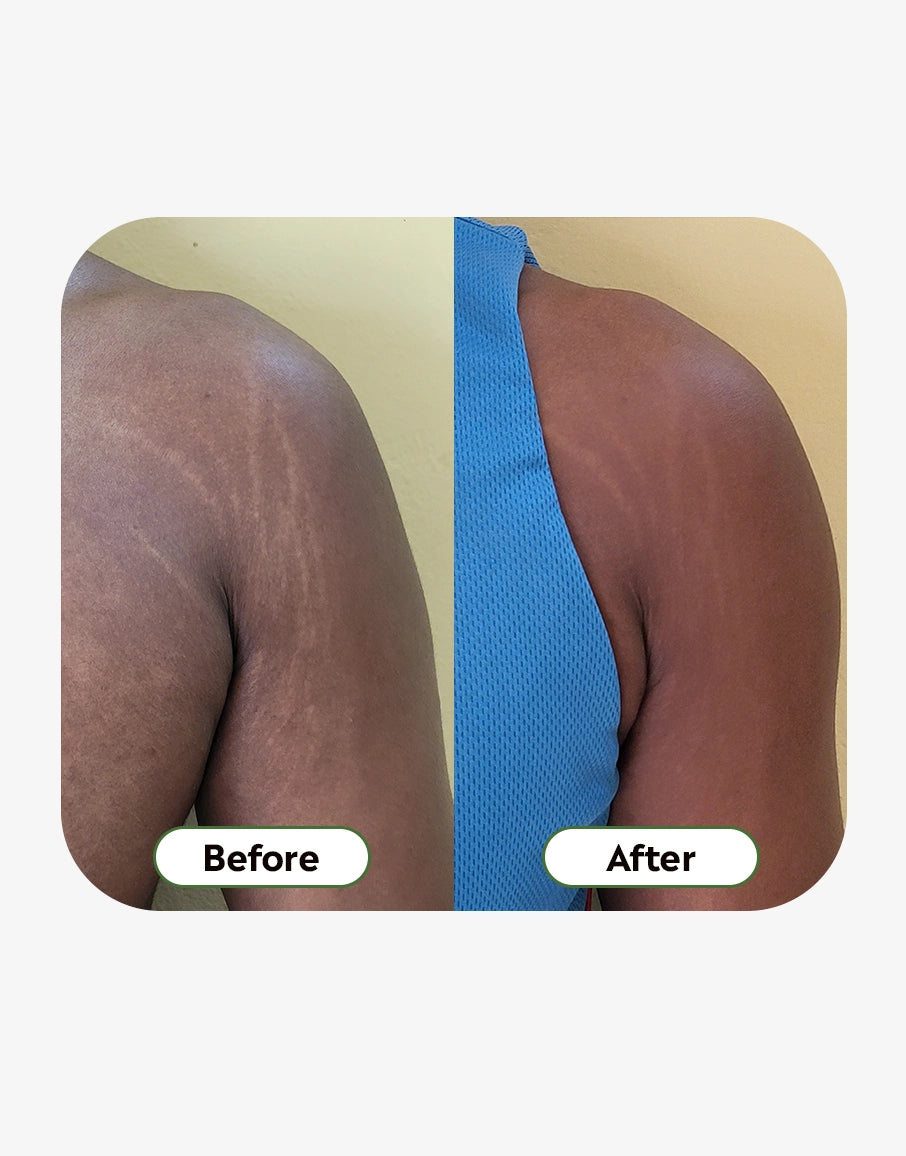 Stretch Marks Cream