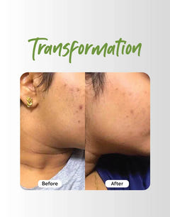 Transformation of skin Before and after using Deyga clear skin combo