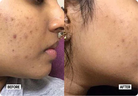  Deyga Orange & Almond Face Pack Mini before & after