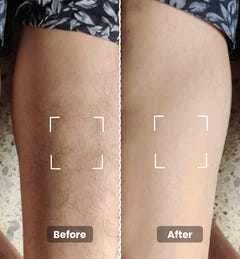 Instant Hair Removal Combo