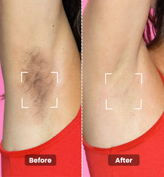 Instant Hair Removal Combo
