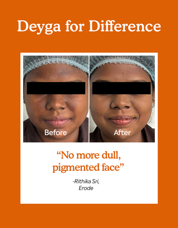 10%  vitamin c serum - before and after difference