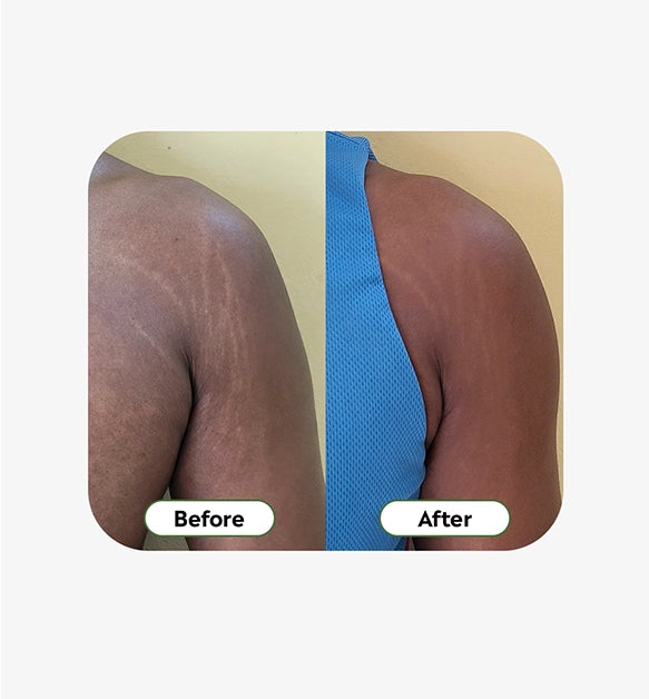 Stretch Marks Cream 100g