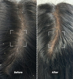 Anti Dandruff Oil