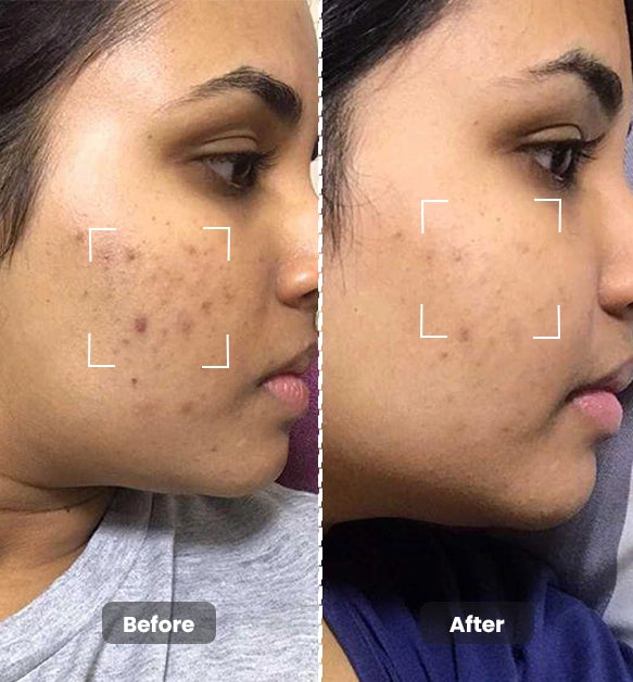 Clear Skin Combo
